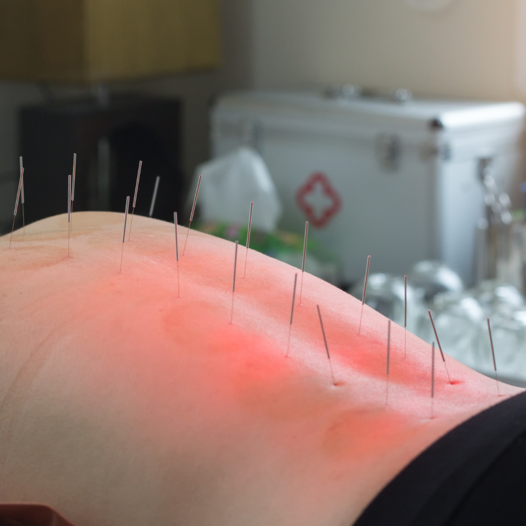 Acupuncture Near Me