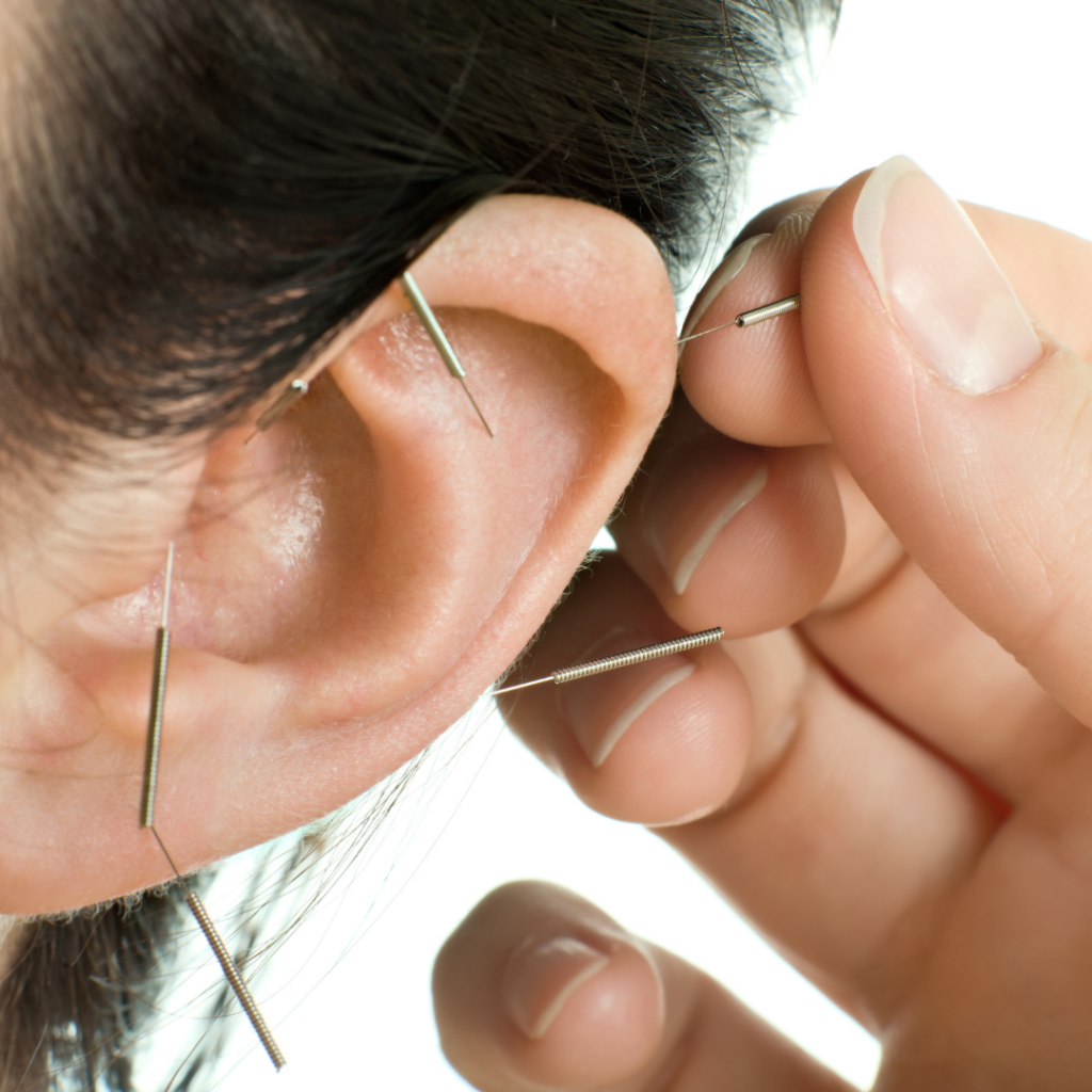 ear acupunctrue stress sunmed noosa sunshine coast